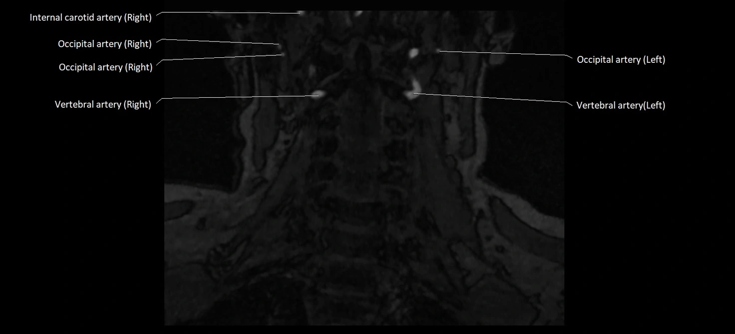 MRA carotid artery anatomy cross sectional 3T coronal image 12.webp